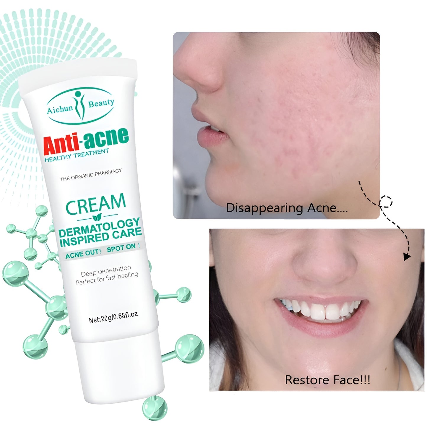 Aichun Beauty™ Anti-Acne Cream – Elimina Granos, Reduce Inflamación y Aclara la Piel Rápidamente