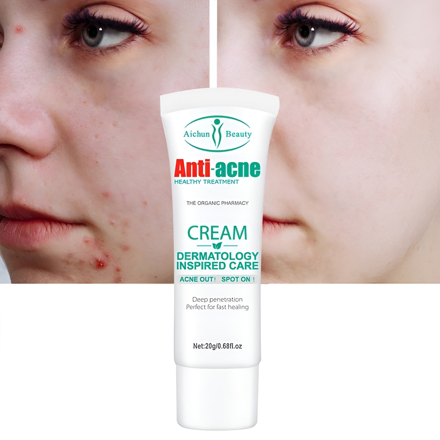 Aichun Beauty™ Anti-Acne Cream – Elimina Granos, Reduce Inflamación y Aclara la Piel Rápidamente